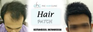 hair patches