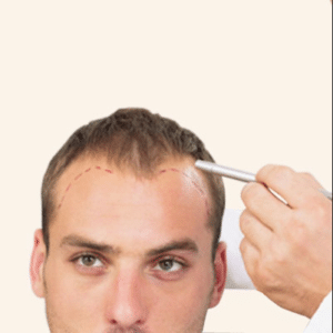 Exactly Difference Between Hair Weaving and Hair Transplant